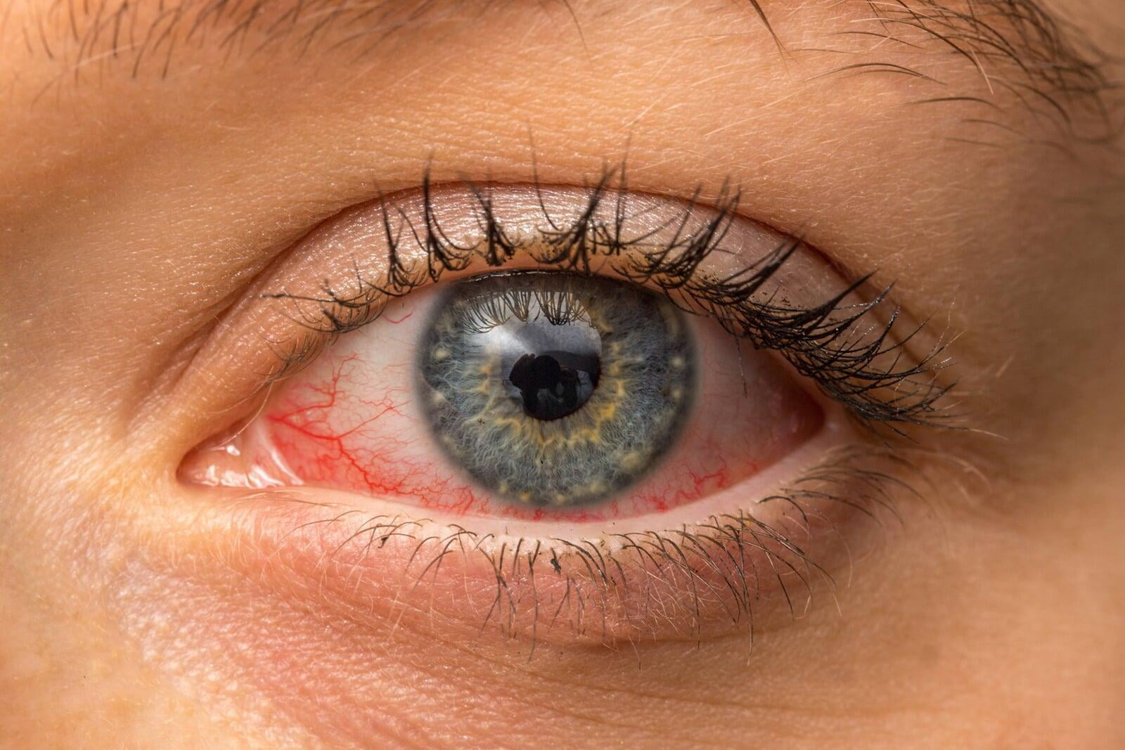 Add "red eyes" as an early symptom of Cov2